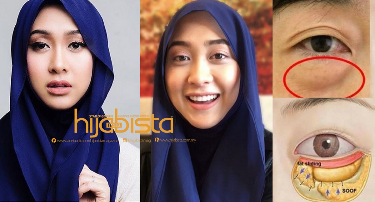 10 Cara Atasi Masalah Kantong Mata Atau Eye Bag Tanpa 