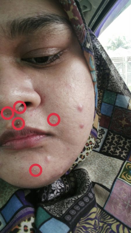 Bukan Jerawat Biasa, Gadis Ini Kongsi Tips Merawat Fungal 