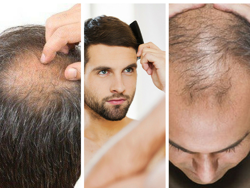 Dah Mula Botak Sebab Rambut Gugur? Ini Tip Mudah Yang Anda Boleh Ikut